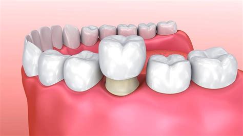 dental crowns arvada|Dental Crowns and Bridges .